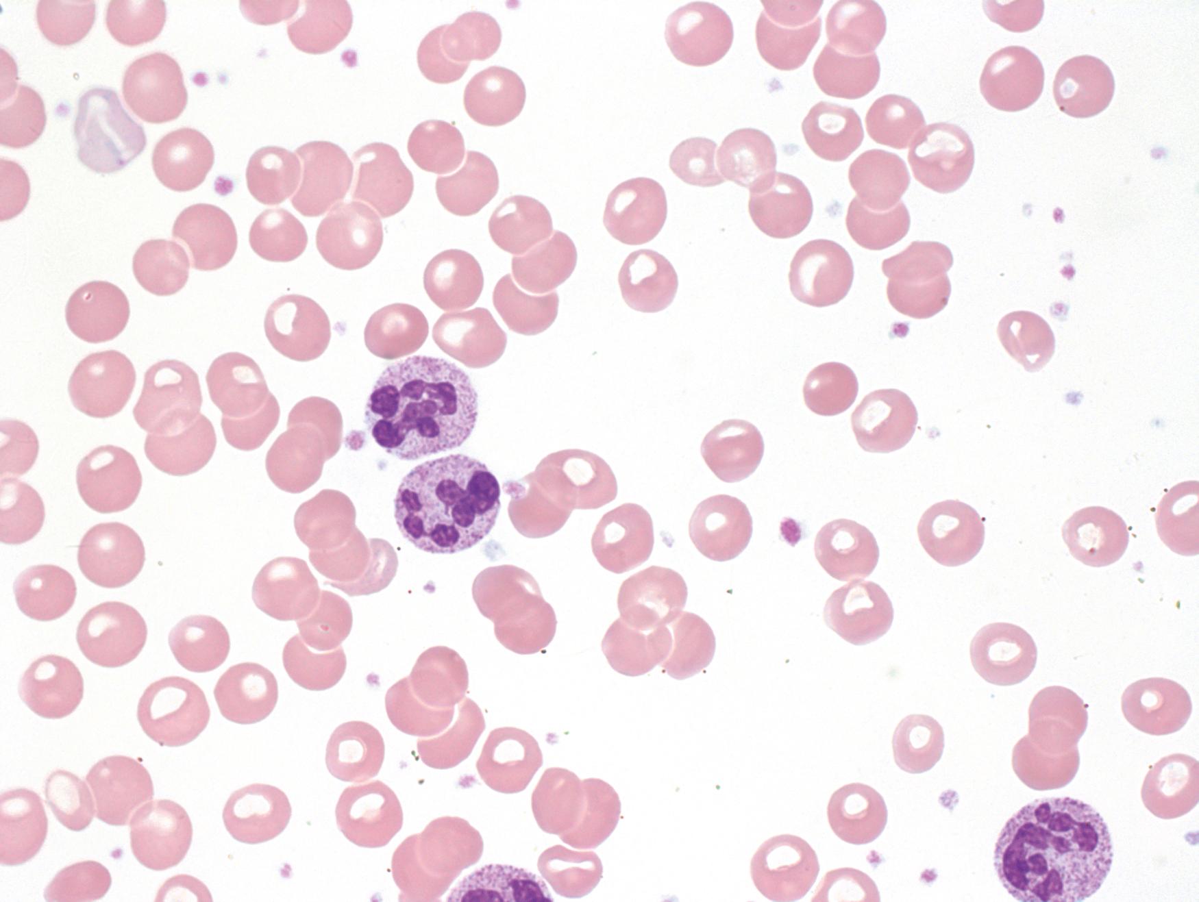 Fig. 4.4, Peripheral blood smear (×400) showing pronounced hypersegmentation of the neutrophil nuclei.