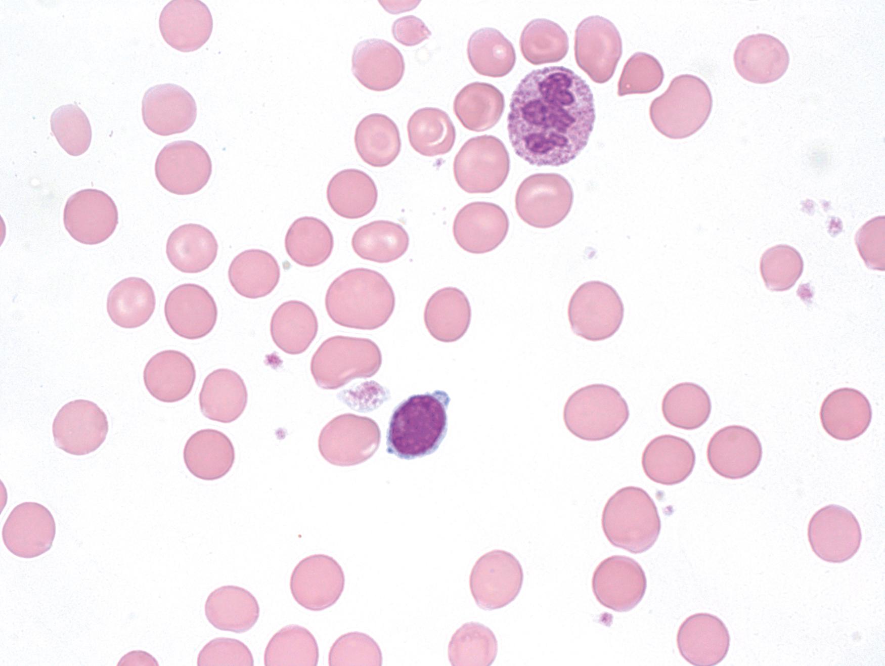 Fig. 4.5, Peripheral blood smear (×400) with moderate anisocytosis, occasional oval macrocytes, and hypersegmented neutrophils.