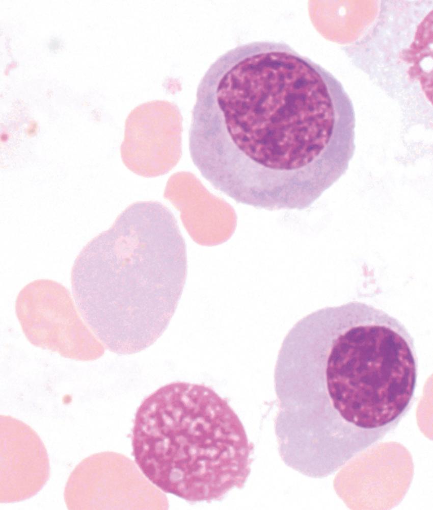 Fig. 4.6, Wright-Giemsa–stained bone marrow aspirate (×1000) showing erythroid precursors with marked nuclear cytoplasmic dyssynchrony as noted by orthochromic normoblast with pale gray cytoplasm and marked nuclear enlargement with immature-appearing nuclear chromatin.