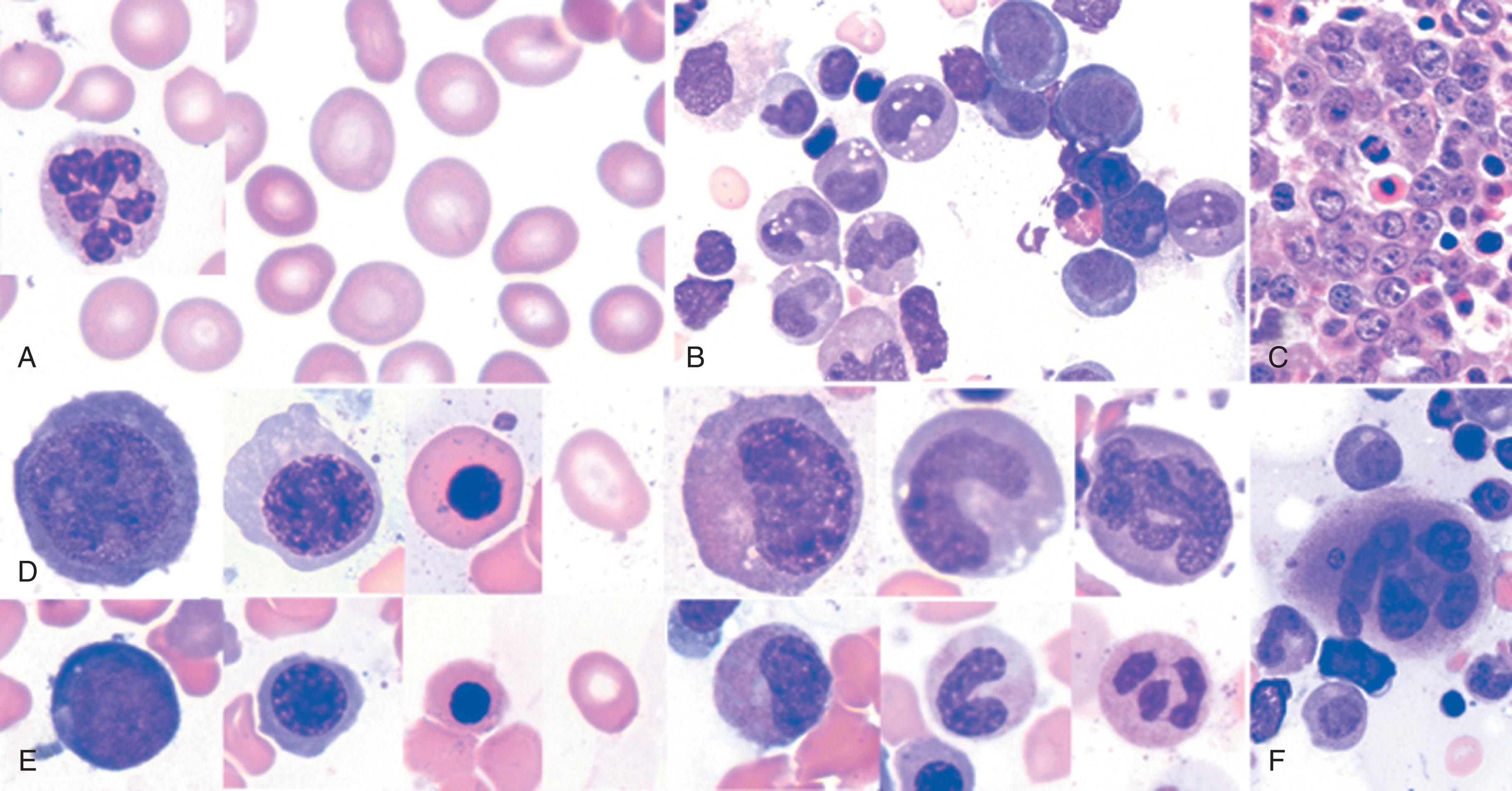 Figure 40.7, MEGALOBLASTIC ANEMIA.