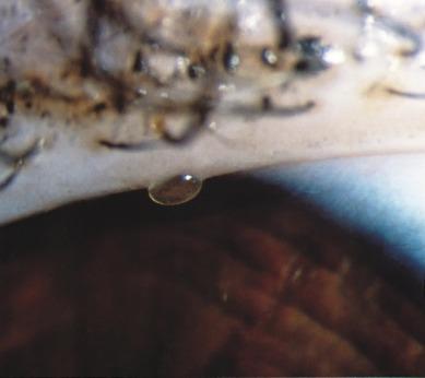 Fig. 7.12, Clear secretion expressed from a normal meibomian gland in the upper lid.