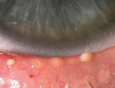 Fig. 7.14, Inspissated secretion from the meibomian glands in the lower lid of a contact lens wearer.