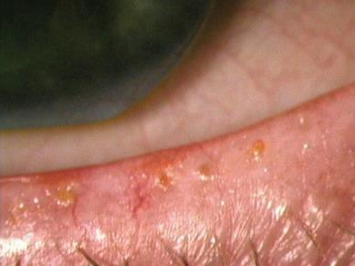 Fig. 7.16, Plugs of keratinised epithelium and dried lipid secretions blocking meibomian gland orifices.