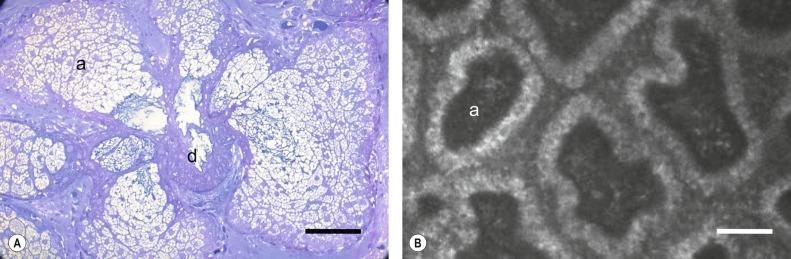 Fig. 7.4, Histology of the meibomian glands. (A) Light micrograph of section through meibomian gland. A number of acini (a) are seen surrounding the central duct (d). The secretory cells within the acini are resolved. (B) Meibomian gland acini (a) viewed with the laser scanning confocal microscope. Large cells can be seen lining the acini, and fine cellular material can be resolved within the acini lumen. The complete borders of three acini are visible.