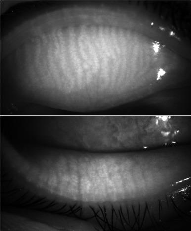 Fig. 7.5, Infrared imaging of the meibomian glands viewed in the everted upper lid (top) and everted lower lid (bottom).