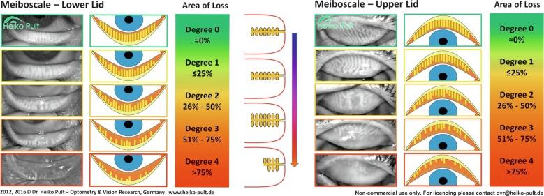 Fig. 7.8, Meiboscale for assessing the severity of meibomian gland dysfunction (MGD) in the lower and upper lids. The central panel illustrates various forms of pathology of the meibomian glands; from top to bottom, normal gland; blocked orifice; gland distention; gland atrophy (partial drop-out).