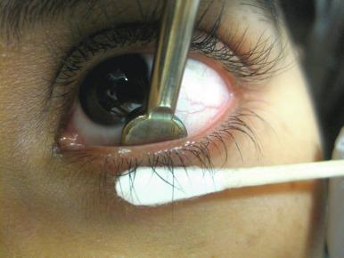 Fig. 7.10, Mastrota paddle being used to evaluate the functioning of the meibomian glands.