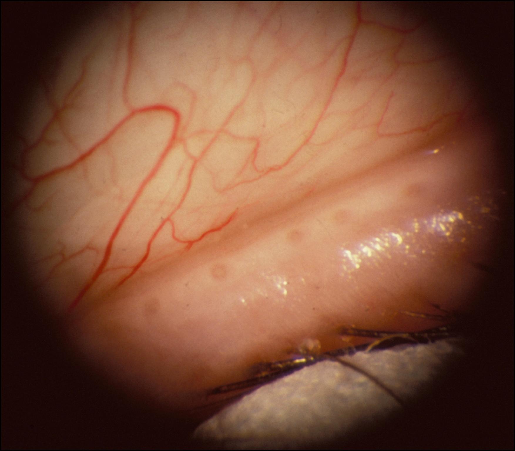 Fig. 33.1, Normal meibomian gland orifices.