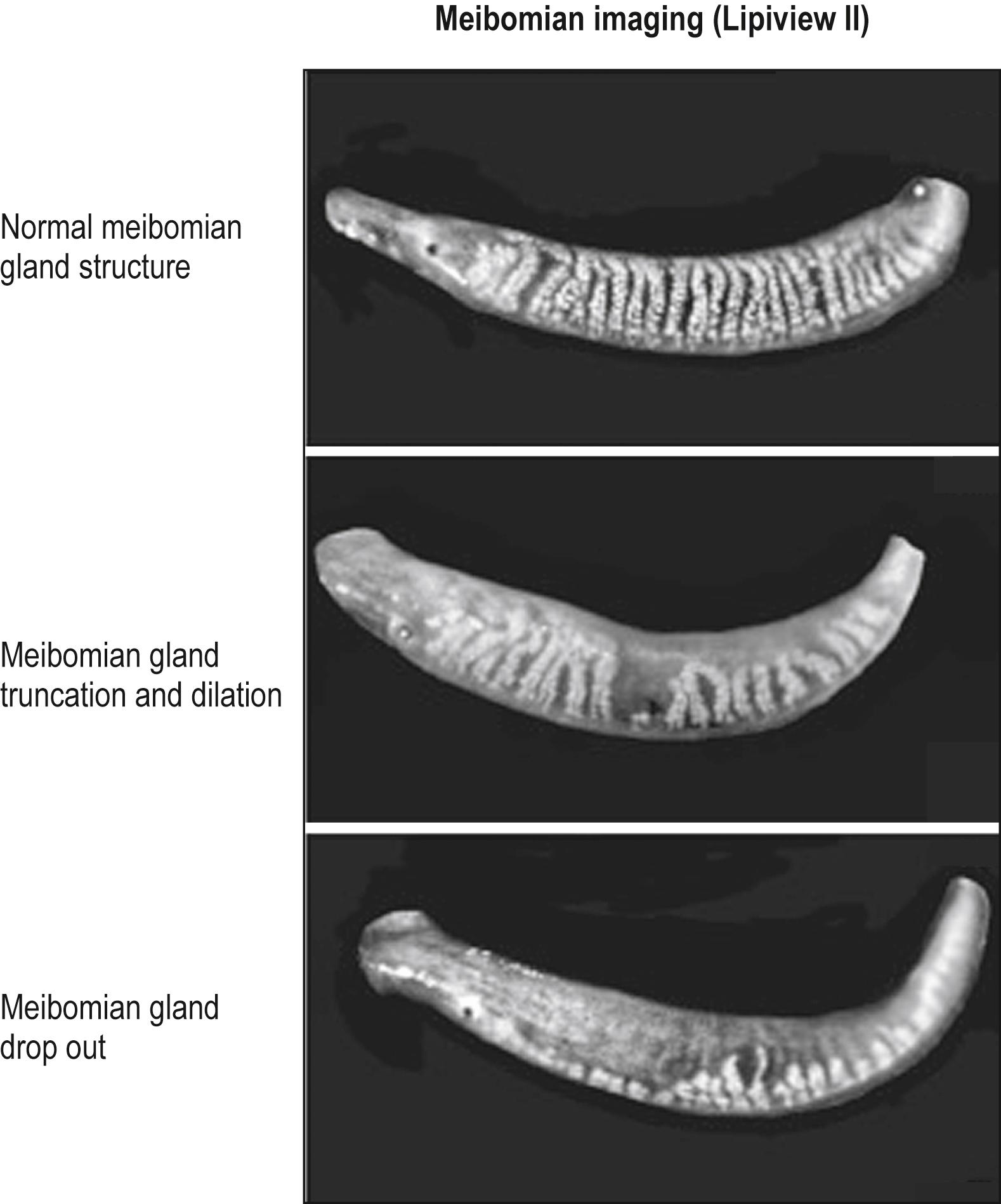 Fig. 33.3, Imaging of meibomian glands by the LipiView II instrument.