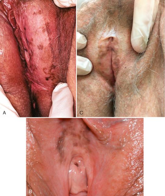 Fig. 8.1, Vulvar melanosis. A, Multiple macules are typical. B, Multiple supraurethral macules. Despite the irregular contours, the even color and macular (flat) disposition are reassuring features. C, Vulvar melanosis associated with lichen sclerosus. There is loss of the labia minora and whitening consistent with lichen sclerosus. Melanosis is present at the site where the labia minora were previously.