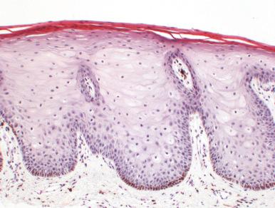 Fig. 8.2, Vulvar lentigo. There is marked basal layer pigmentation, and melanocytes are increased in number SM .