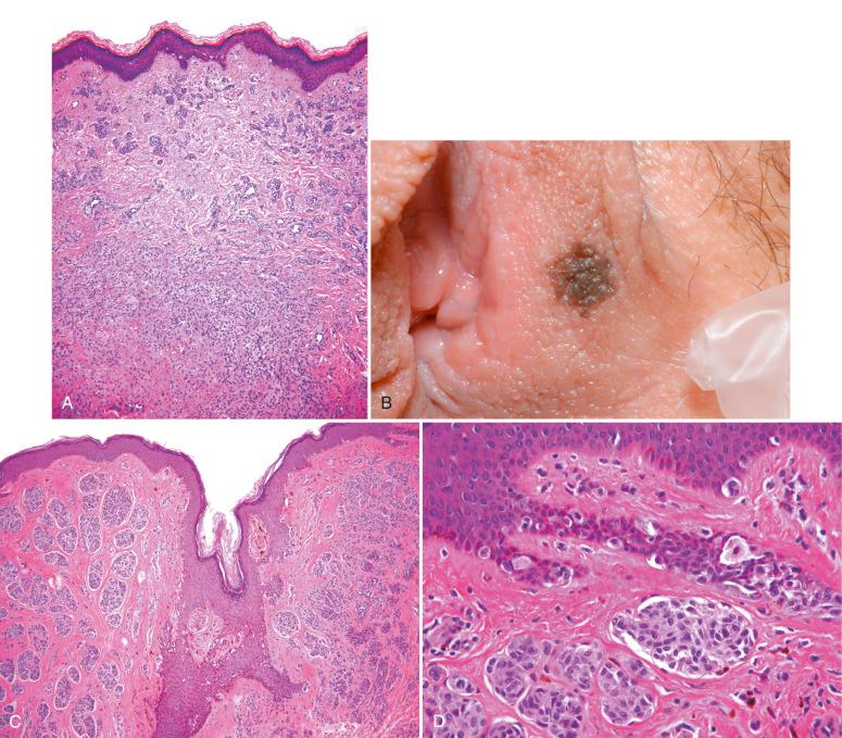 Fig. 8.3, A, Dermal nevus in the vulvar skin. B, Compound nevus in the vulva. A single, small pigmented lesion on the inner labium minus shows a symmetric silhouette, regular borders, and even color. C, Compound nevus with regular nests of nevomelanocytes and junctional proliferation predominantly of single units. D, The melanocytes in the junctional component show minimal atypia.