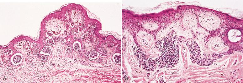 Fig. 8.4, Atypical genital-type nevus. A, Low-power view showing large junctional nests with well-developed retraction artifact. B, In this lesion, there is bridging and focal cytologic atypia.