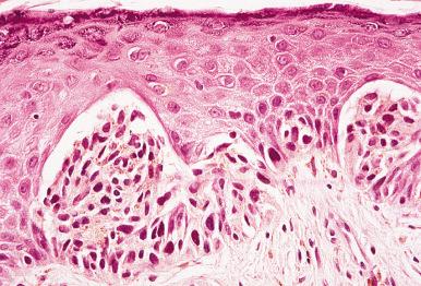 Fig. 8.5, Atypical genital-type nevus. Note the retraction artifact and atypical hyperchromatic irregular nuclei.