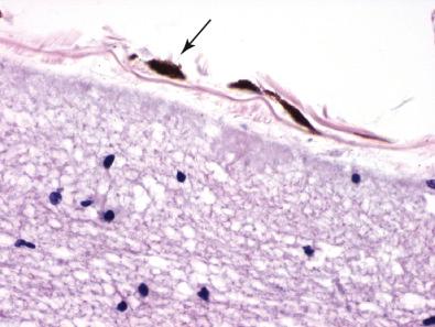 Fig. 19.1, Leptomeningeal melanocytes (arrow) are associated with the pia and arachnoid membranes. They are usually widely scattered individual cells that are flattened, have occasional processes, and contain abundant melanin.