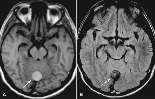 Fig. 19.2, Magnetic resonance imaging (MRI) of a leptomeningeal melanocytoma arising in the occipital lobe. The mass is extra-axial, well circumscribed, hyperintense on T1-weighted images (A) and hypointense on fluid-attenuated inversion recovery (FLAIR; and T2-weighted) images (B) consistent with a melanocytoma.