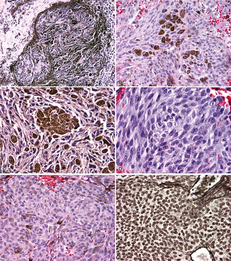 Fig. 19.3, Histopathologic features of melanocytoma. The classic growth pattern of melanocytoma shows tight nesting of well-differentiated, spindled tumor cells surrounded by highly pigmented cells and extracellular melanin deposits (A). Some melanocytomas contain abundant large, round melanophages packed with clumps of melanin, either individually or in small clusters (B, C). The degree of melanin varies within neoplastic cells, and some melanocytomas only contain minimal melanotic material, which places heavy emphasis on recognizing the characteristic pattern of melanocytic nests and cytologic detail (D, E). Individual tumor cells are cytologically bland with bean-shaped nuclei that show little variability in nuclear size or shape and usually contain a small nucleolus. The distinction between melanotic schwannomas is aided by the lack of reticulin between individual cells in melanocytomas (F).