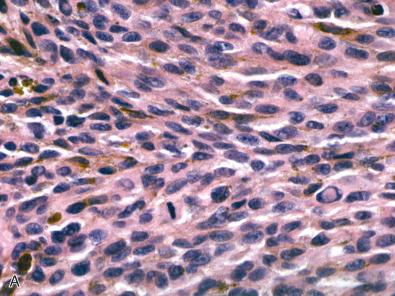 Fig. 19.4, Histopathologic features of primary CNS melanoma. Melanomas are highly cellular and contain cytologically atypical cells with increased mitotic activity. Melanin is evident in individual tumor cells, as well as in intracellular deposits in the tumor stroma, and in melanophages. Individual tumor cells may be arranged as densely packed spindled cells (A) or demonstrate epithelioid qualities, with large atypical nuclei, abundant pink cytoplasm, and cherry red nucleoli (B), features which may also be appreciable on intraoperative cytologic preparations (C). In contrast to melanotic schwannoma, there is often minimal pericellular basement membrane deposition on collagen IV immunostain (D).