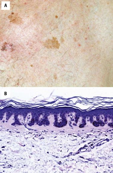 FIGURE 12-1, Solar lentigo. A, Clinically, a slightly irregular brown macule is present. B, Histologically, slightly elongated rete ridges show basal layer hyperpigmentation. There is associated solar elastosis.