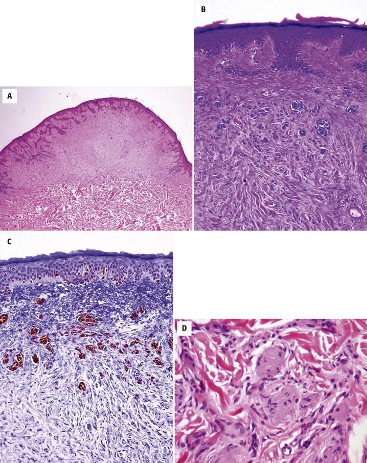 FIGURE 12-11, Neuronevus. A, Silhouette of a compound melanocytic nevus with “neurotization” of its dermal component. B, Superficially, a mixture of nests of small epithelioid melanocytes and diffuse arrangement of fusiform melanocytes with schwannian features is seen. C, Only the epithelioid melanocytes are immunoreactive for Melan-A. The fusiform melanocytes are negative. D, Neuroid structures are present.