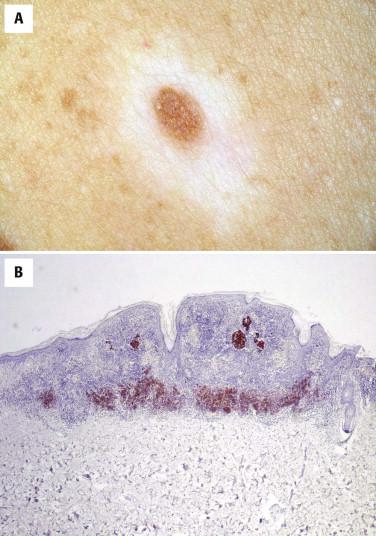 FIGURE 12-12, “Halo” phenomenon. A, Clinically, a brown macule is surrounded by a hypopigmented rim. B, Histologically, the nevomelanocytes (stained immunohistochemically for Melan-A) are associated with a dense lymphocytic infiltrate.