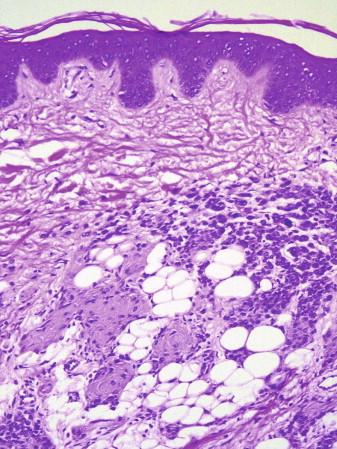 FIGURE 12-13, Melanocytic nevus with fatty changes. Adipocytes are present in association with a dermal melanocytic nevus.