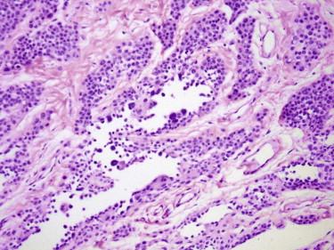 FIGURE 12-14, Pseudovascular changes of a melanocytic nevus. Artifactual clefts are lined by melanocytes.