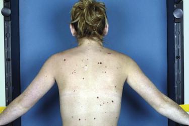 FIGURE 12-15, Dysplastic nevus syndrome. A patient with numerous clinically irregular melanocytic nevi.