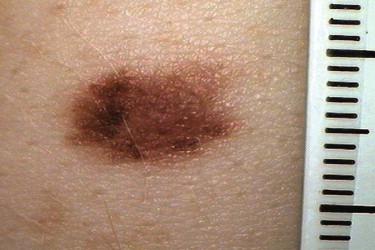 FIGURE 12-16, Dysplastic nevus. Pigmented lesion with fuzzy borders and variations in colors and texture.