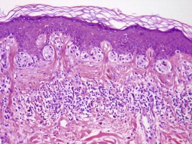 FIGURE 12-17, Dysplastic nevus. Bridging and fusion of junctional nests of atypical melanocytes are apparent. There is associated dermal fibrosis and inflammation.