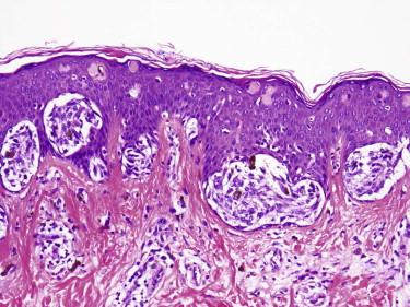 FIGURE 12-22, Junctional Spitz's nevus. Nests of large plump spindle and epithelioid melanocytes are present with clefts surrounding junctional nests. Dull pink globules (“Kamino” bodies) are also identified.