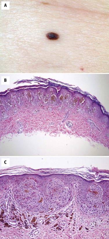 FIGURE 12-26, Pigmented Spitz's nevus. A, A small dark circumscribed melanocytic nevus is seen. B, Histologically, it is composed of many nests of melanocytes at the dermal-epidermal junction surrounded by clefts, and associated with epidermal hyperplasia and hyperpigmentation. C, The nests are composed of slender pigmented fusiform melanocytes.