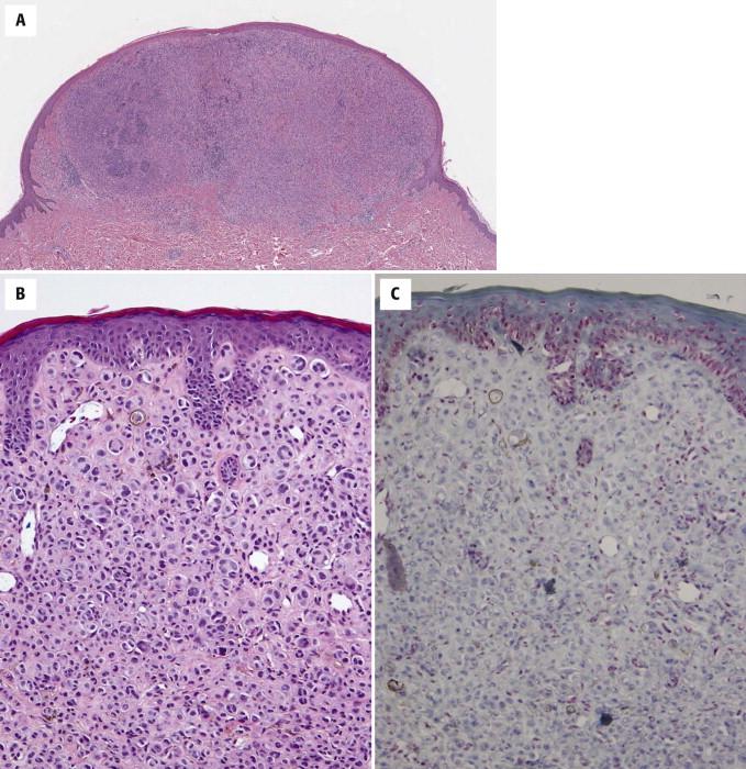 FIGURE 12-27, Epithelioid Spitz's nevus with loss of BAP1 expression. A, Polypoid nodule. B, The tumor is composed of large epitheloid melanocytes. A few lymphocytes are present. C, The large melanocytes lack nuclear labeling for BAP1.