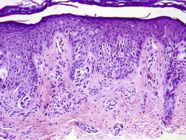 FIGURE 12-28, Pagetoid Spitz's nevus. This spindle and epithelioid melanocytic nevus from an 8-year-old child shows many melanocytes above the basal cell layer.