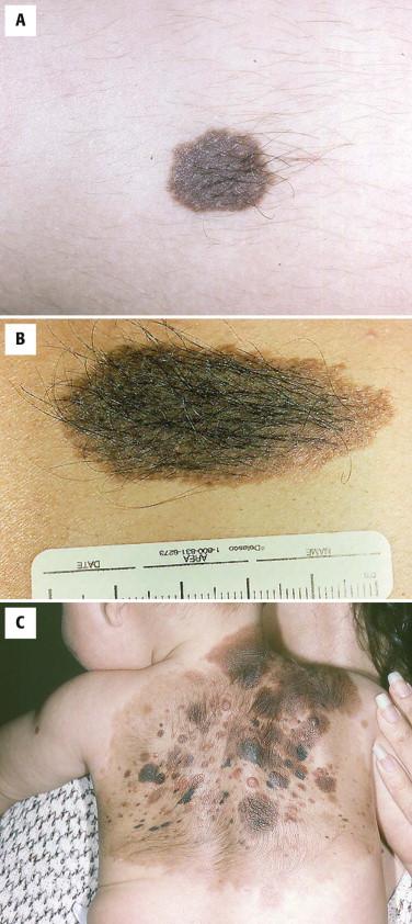 FIGURE 12-29, Congenital melanocytic nevus. A, Small congenital nevus. B, Medium-sized congenital nevus. C, Giant hairy nevus.