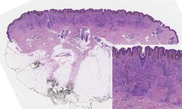 FIGURE 12-30, Congenital melanocytic nevus. Broad plaque-like compound melanocytic proliferation extending into the reticular dermis. Involvement of adnexal structures by melanocytes is seen (inset).