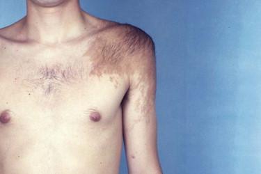 FIGURE 12-3, Becker's nevus. There are unilateral hyperpigmentation and hypertrichosis of the left shoulder region.