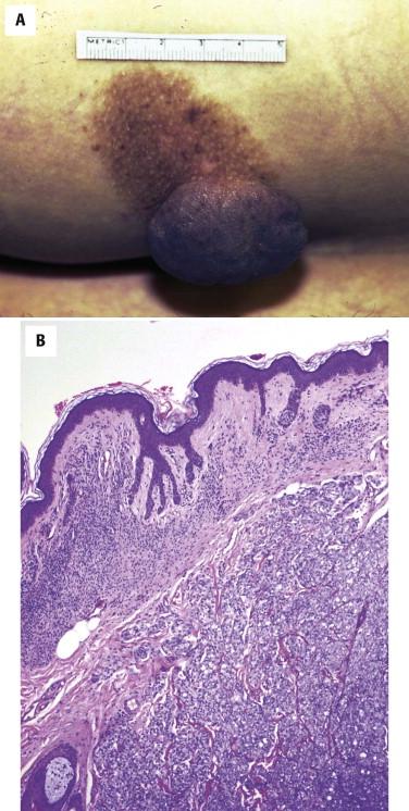 FIGURE 12-32, Melanoma arising in association with a congenital nevus. A, A polypoid nodule is present in association with a medium-sized congenital nevus. B, Superficially, bland nevomelanocytes are present. Underneath is a dermal melanoma composed of atypical epithelioid tumor cells.