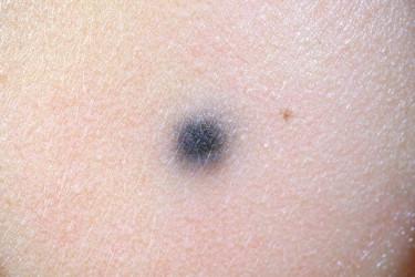 FIGURE 12-33, Common blue nevus (BN). Common BN presenting as a small bluish papule.