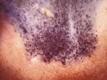FIGURE 12-34, Plaque-type blue nevus (BN). Rare plaque-type BN presenting as a large pigmented bluish-brown plaque with mottled pigmentation.