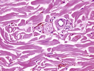 FIGURE 12-35, Melanocytosis. Scattered and widely spaced isolated fusiform melanocytes and melanophages are seen in the dermis.