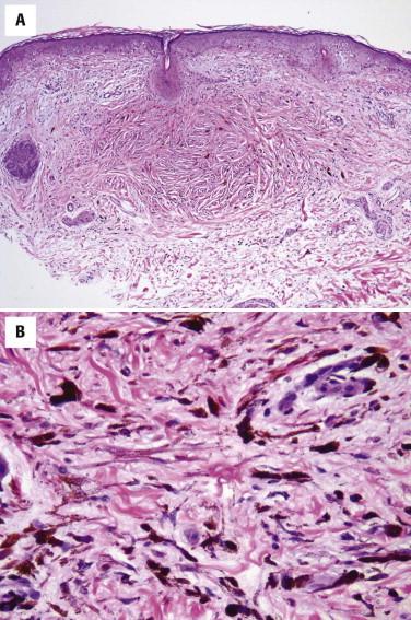 FIGURE 12-36, Common blue nevus. A, A perifollicular pigmented lesion is present associated with mild dermal fibrosis. B, It is composed of pigmented fusiform and dendritic melanocytes as well as macrophages.