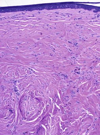 FIGURE 12-37, Sclerosing blue nevus (BN). A paucimelanotic BN is seen with prominent dermal fibrosis.