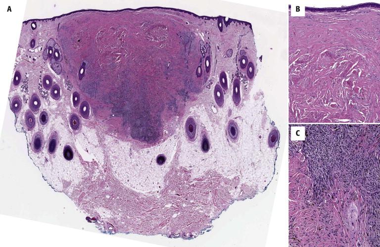 FIGURE 12-38, Sclerosing blue nevus with cellular areas. A, Nodular melanocytic nevus involving the dermis and subcutis of the scalp. B, The superficial part of the lesion is sclerosing. C, The deep part is cellular.