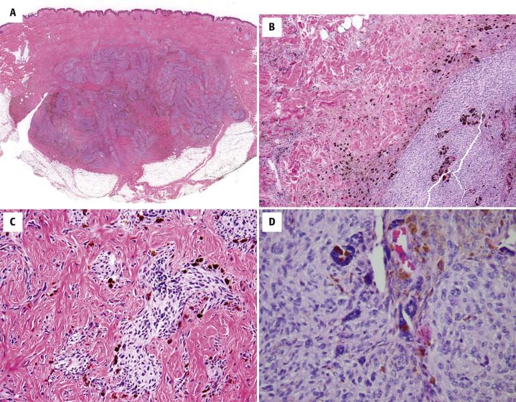 FIGURE 12-39, Cellular blue nevus (BN). A, Biphasic cellular nodule in the dermis. B, Densely packed groups of pale spindle cells adjacent to paucicellular fibrotic area with conventional BN-like features. C, Aggregates of cytologically bland pale melanocytes with surrounding fibrotic stroma. D, Cellular area with multinucleated melanocytes.