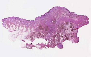 FIGURE 12-41, Plaque-type blue nevus (BN) with cellular nodules. BN grows in a broad plaque-like pattern in the skin and soft tissue. Multiple cellular nodules are seen.