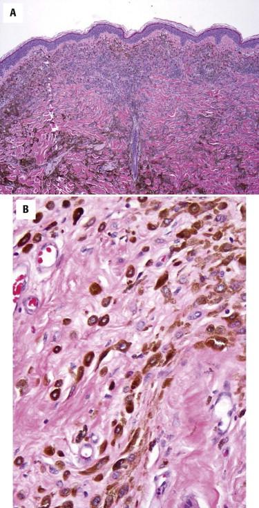 FIGURE 12-42, Epithelioid blue nevus. A, Pigmented compound melanocytic nevus with congenital pattern. B, The nevus is composed of many pigmented epithelioid melanocytes; some cells display bipolar dendritic processes.