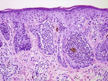 FIGURE 12-44, Melanocytic nevus of flexural site. A compound melanocytic nevus is present with many large nests and variation in the size and shape of nests.