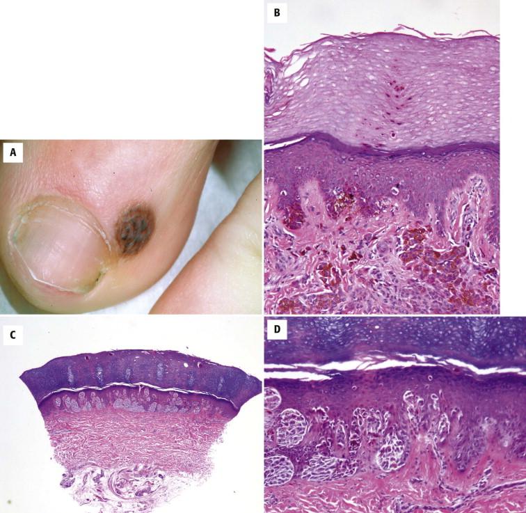 FIGURE 12-45, Melanocytic nevus of acral skin. A, A circumscribed pigmented macule is seen near the toenail. B, Silhouette of nevus with predominant nested pattern and sharp lateral demarcation. C, A compound melanocytic nevus with superficial dermal pigmentation is present. A vertical column of melanin pigment is seen in the stratum corneum. D, Pagetoid spread of cytologically bland melanocytes may be seen in an acral nevus.