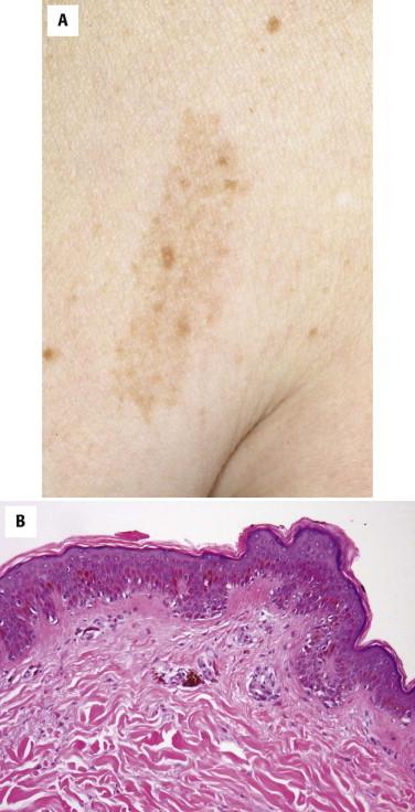 FIGURE 12-46, Nevus spilus. A, A light brown macular lesion is present with darker brown spots within it. B, There is a focus of a lentiginous melanocytic proliferation in a background of basal layer hyperpigmentation.